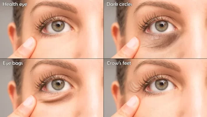 Soskin EYE CONTOUR FILLER يمليء الخطوط التعبيرية بنسبة 80٪. يستهدف ويملأ 70٪ من التجاعيد في منطقة العين و يقلل من ظهور الهالات السوداء بنسبة 70٪ 