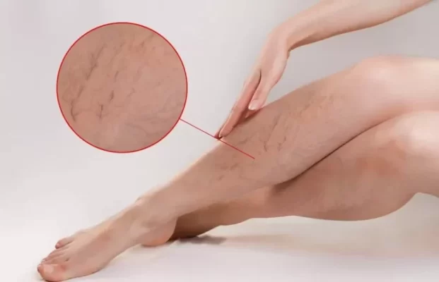 COSMO BODY STRETCH MARK يمنع و يسرع تلاشي علامات التمدد التي تظهر نتيجة الحمل،زيادة الوزن، فقدان الوزن السريع،