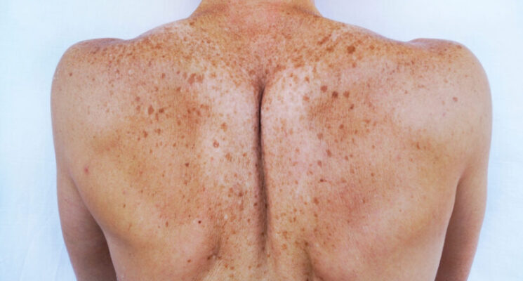 BRUNOVASSARI BODY PEEL