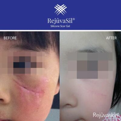 سيليكون جل ريجوفاسيل RejuvaSil Silicone Scar Gel 10ML