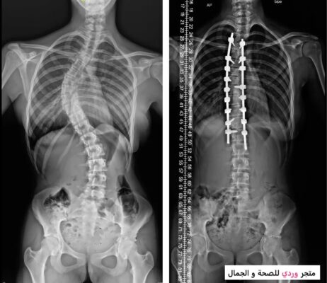 الجنف : دليل شامل لفهم وعلاج مرض الجنف